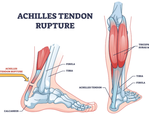 Achilles Rupture – Surgery vs Conservative Treatment