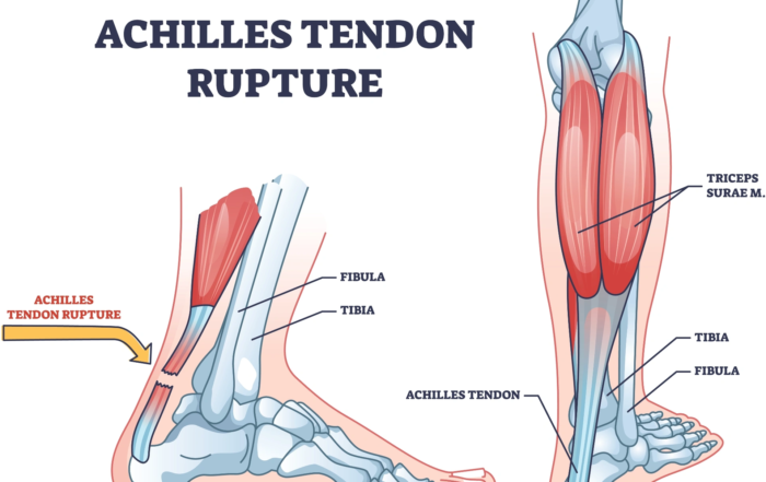 Achilles Rupture