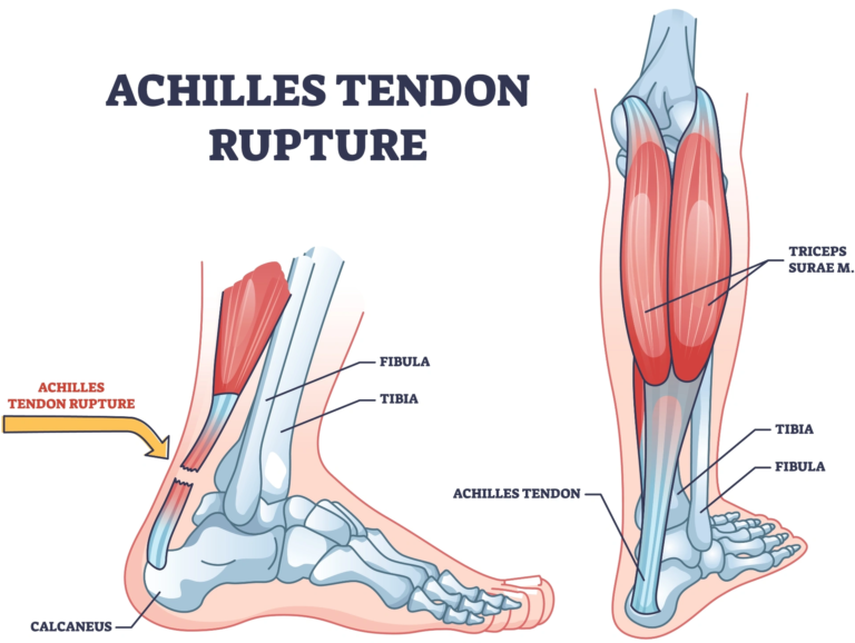 Calf Tear – Tennis Leg