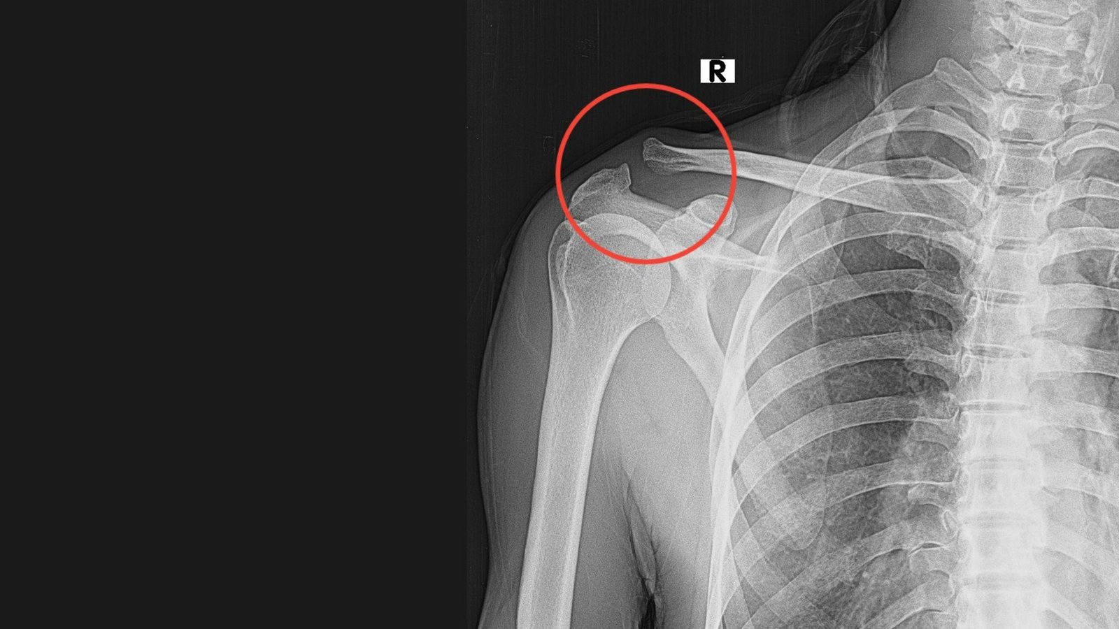 X-ray of a right shoulder with a red circle highlighting an acromioclavicular joint separation