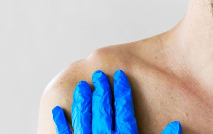 Clinician examining a raised acromioclavicular joint at the top of the right shoulder