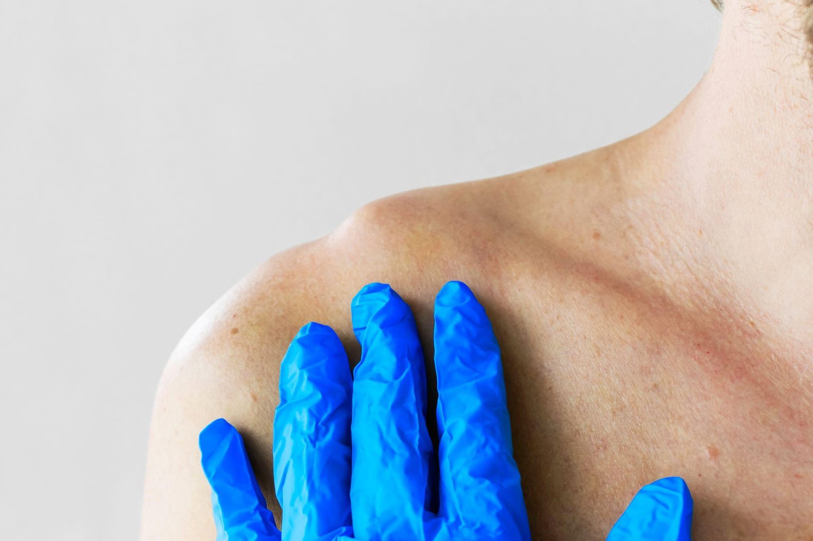 Clinician examining a raised acromioclavicular joint at the top of the right shoulder
